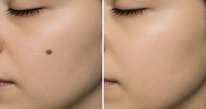 Mole Removal treatment